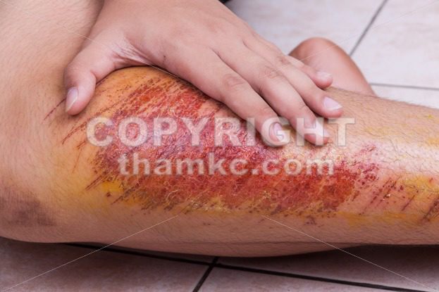 Closeup hand embracing injured knee with painful abrasion from fall - ThamKC Royalty-Free Photos