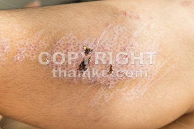 Closeup on injured knee with scar from abrasion healing - ThamKC Royalty-Free Photos