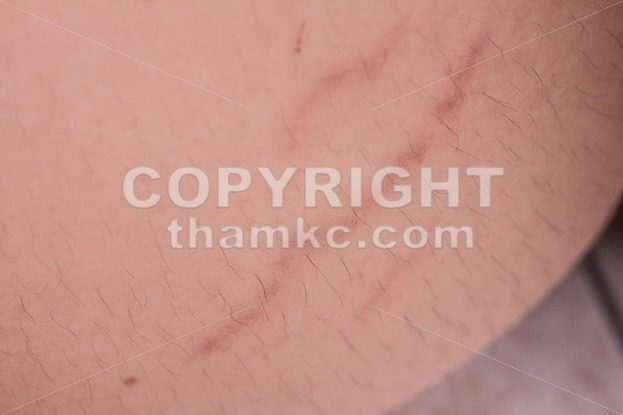 Closeup on stretch marks or cellulite on waist belly - ThamKC Royalty-Free Photos