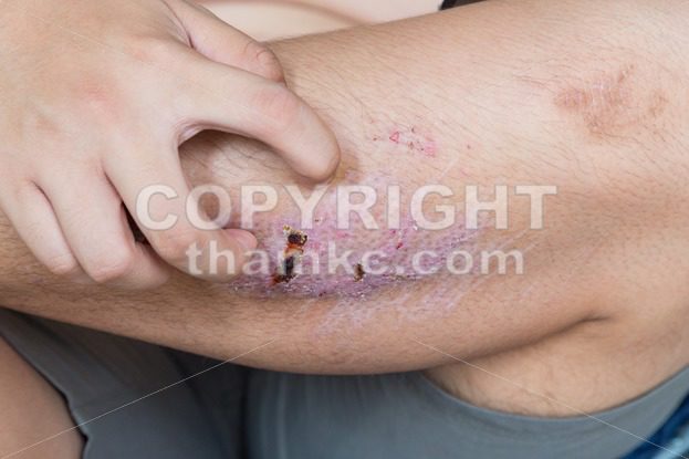 Finger scratching itchy knee with healing injury from abrasion - ThamKC Royalty-Free Photos