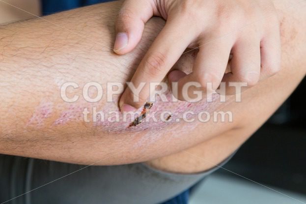 Finger scratching itchy knee with healing injury from abrasion - ThamKC Royalty-Free Photos