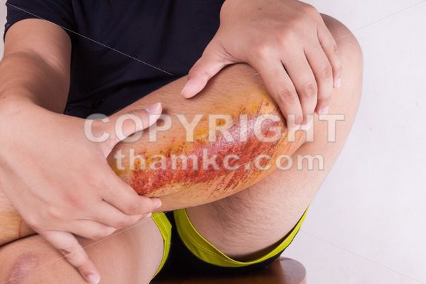 Hand embracing injured knee with painful abrasion from fall - ThamKC Royalty-Free Photos