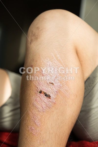 Injured knee with scar from abrasion healing - ThamKC Royalty-Free Photos