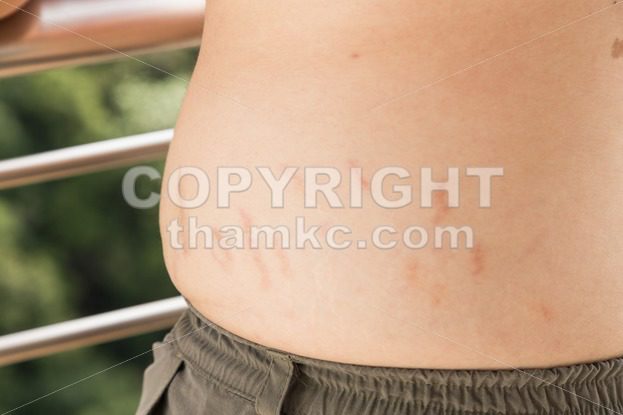 Stretch marks or cellulite on waist belly - ThamKC Royalty-Free Photos