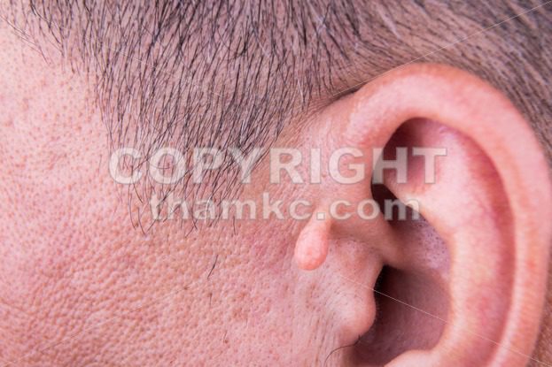 Human mutation with extra growth on ear - ThamKC Royalty-Free Photos