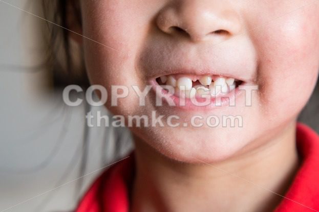 Kid with toothless and deformed front teeth - ThamKC Royalty-Free Photos