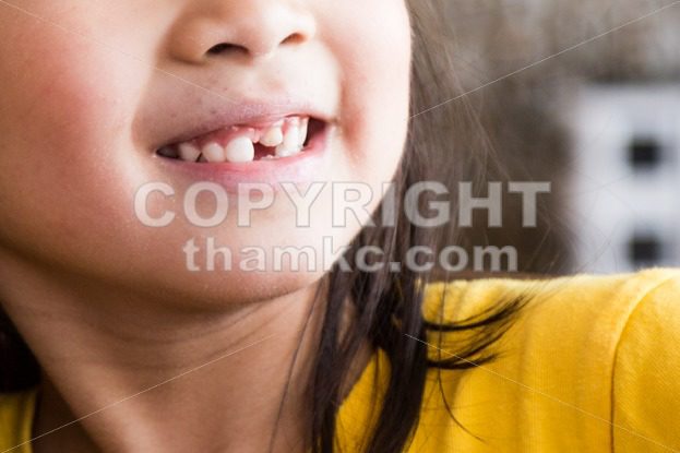 Kid with toothless and deformed front teeth - ThamKC Royalty-Free Photos