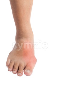 Deformed right big toe with painful gout inflammation stock photo image ...